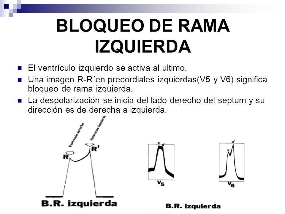 BLOQUEO RAMA IZQUIERDA EBOOK DOWNLOAD BLOQUEO RAMA IZQUIERDA EBOOK DOWNLOAD